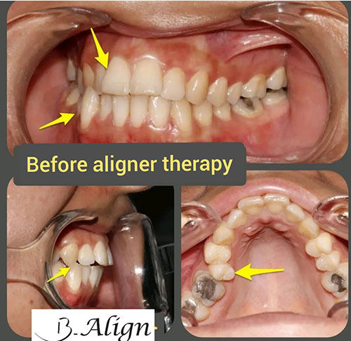 English | B-Align Clear Aligners